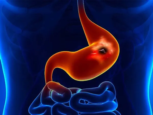 TÁC DỤNG CỦA VIÊN NGHỆ MẬT ONG 12 Viên nghệ mật ong hỗ trợ làm giảm viêm loét dạ dày, tá tràng