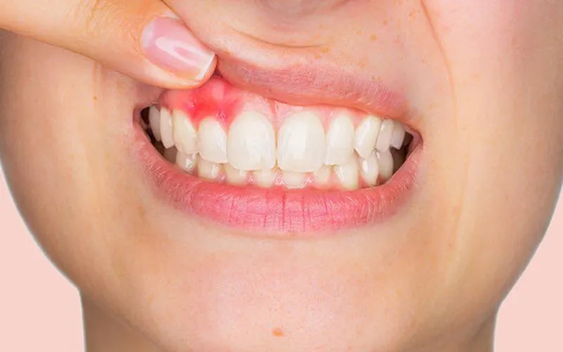 MẸO HAY CHỮA VIÊM LỢI BẰNG MẬT ONG HIỆU QUẢ NHANH, KHÔNG ĐAU RÁT 14 Image 7