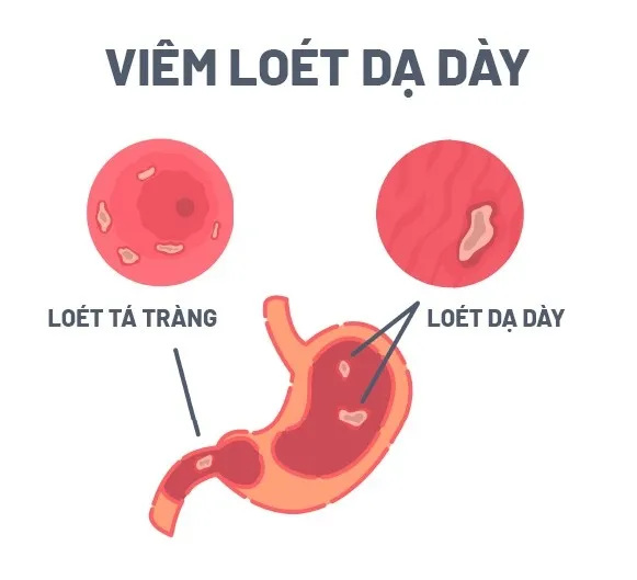 Benh Viem Loet Da Day Ta Trang La Gi